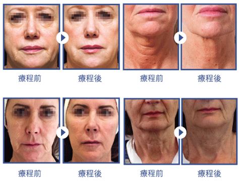 逆時針|逆時針 PROFHILO — BEAUSKIN Medical